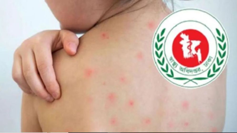 হাম ও হামের উপসর্গ নিয়ে ১০ জনের মৃত্যু